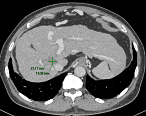Liver tumour 4 months post-IRE