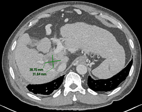 Liver tumour pre-IRE