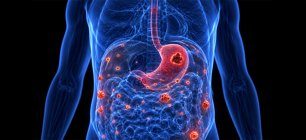 stomach cancer hologram